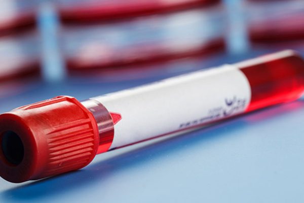 EEUU registra reducción de infección de VIH