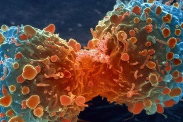 Nuevo medicamento contra el cáncer de mama aumenta tasas de supervivencia