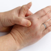La Artritis Reumatoide aumenta como causa de ausentismo laboral