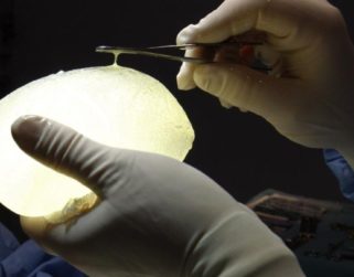 600 venezolanas serán indemnizadas por polémico caso de las prótesis PIP