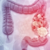 Cáncer de colon se puede curar en el 90% de los casos