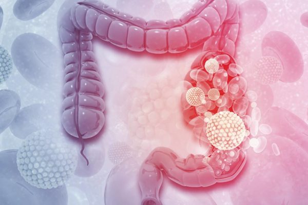 Cáncer de colon se puede curar en el 90% de los casos