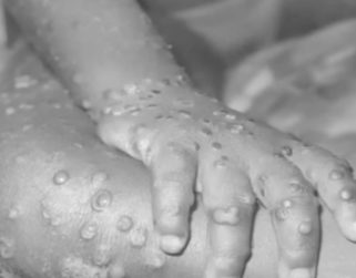 La viruela del mono no es por el momento una emergencia sanitaria, según la OMS