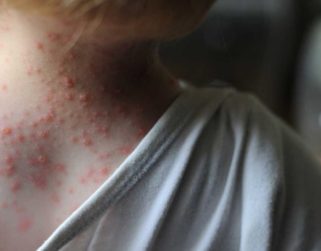 Síntomas parcialmente distintos en primeros casos europeos de viruela del mono