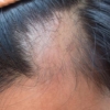 EEUU aprueba fármaco que revierte la alopecia