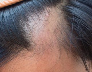 EEUU aprueba fármaco que revierte la alopecia