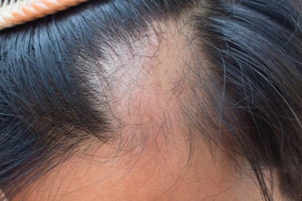 EEUU aprueba fármaco que revierte la alopecia